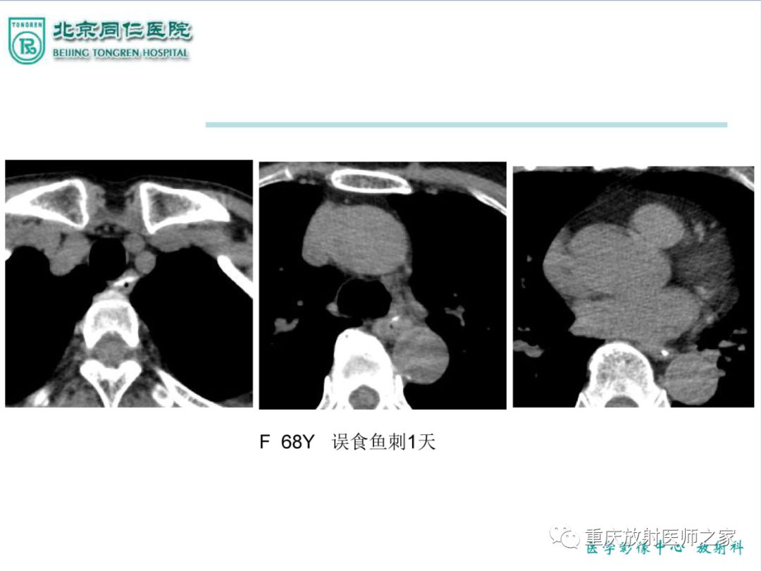 影像PPT - 【PPT】咽喉部病变影像分析-16