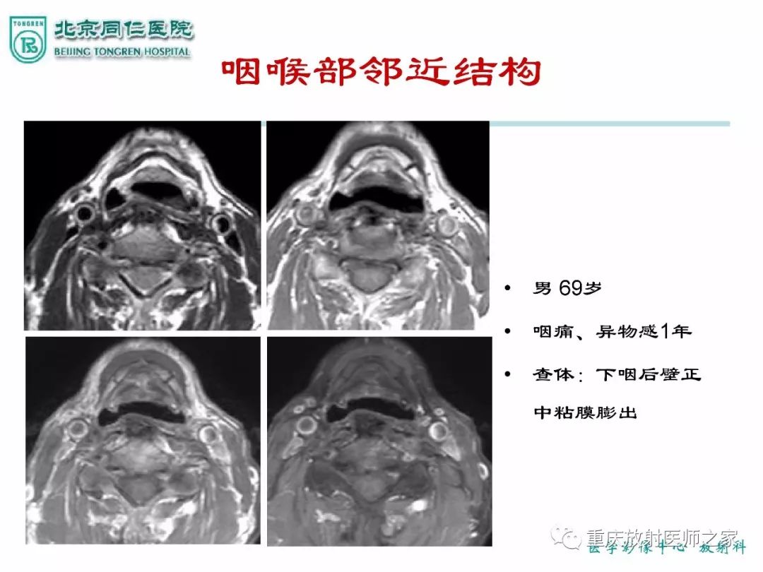 影像PPT - 【PPT】咽喉部病变影像分析-19