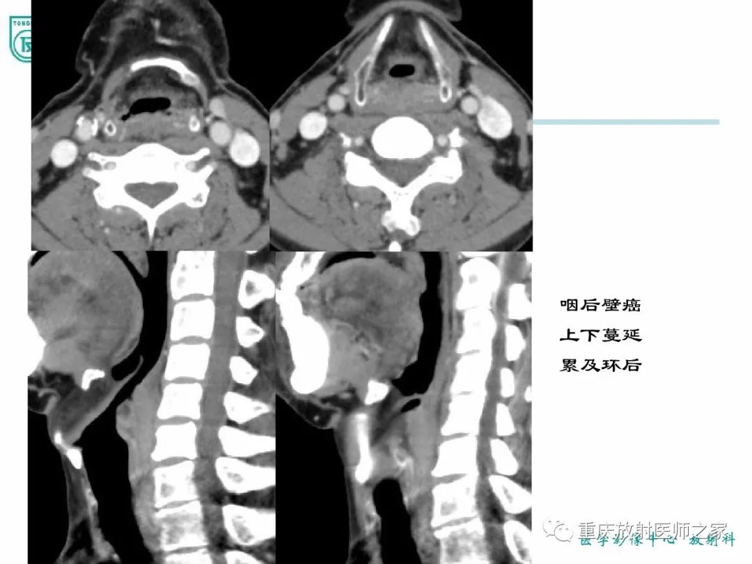 影像PPT - 【PPT】咽喉部病变影像分析-23
