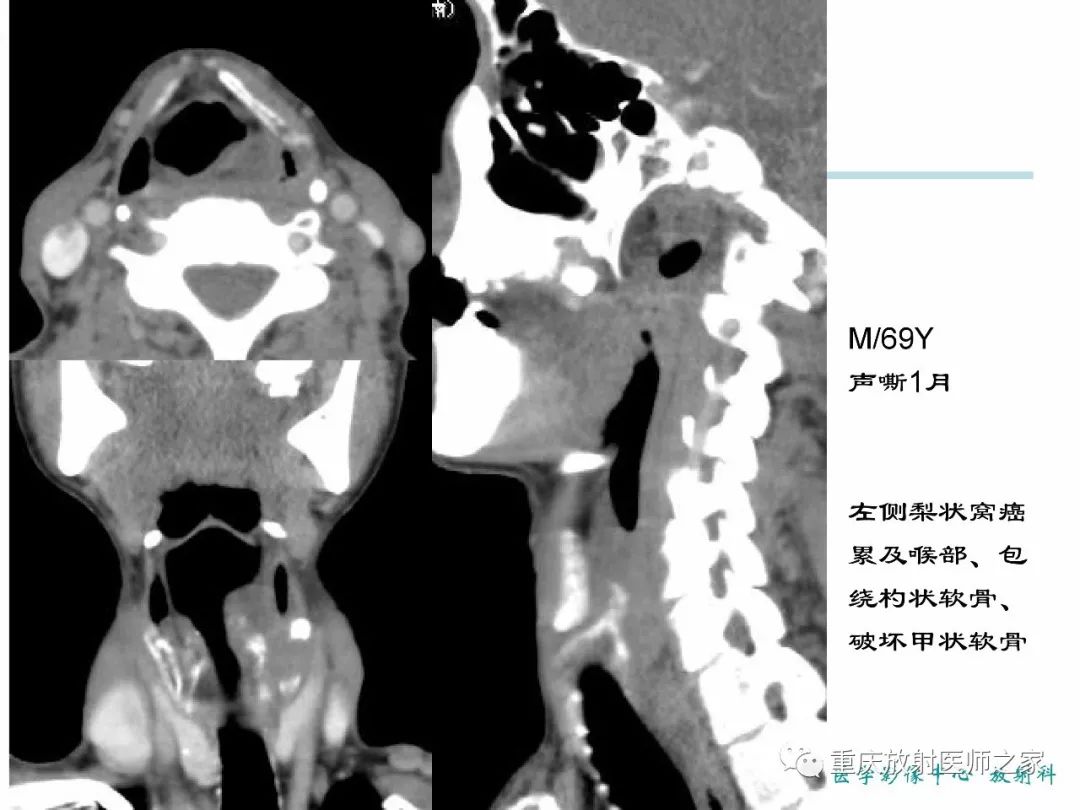 影像PPT - 【PPT】咽喉部病变影像分析-24