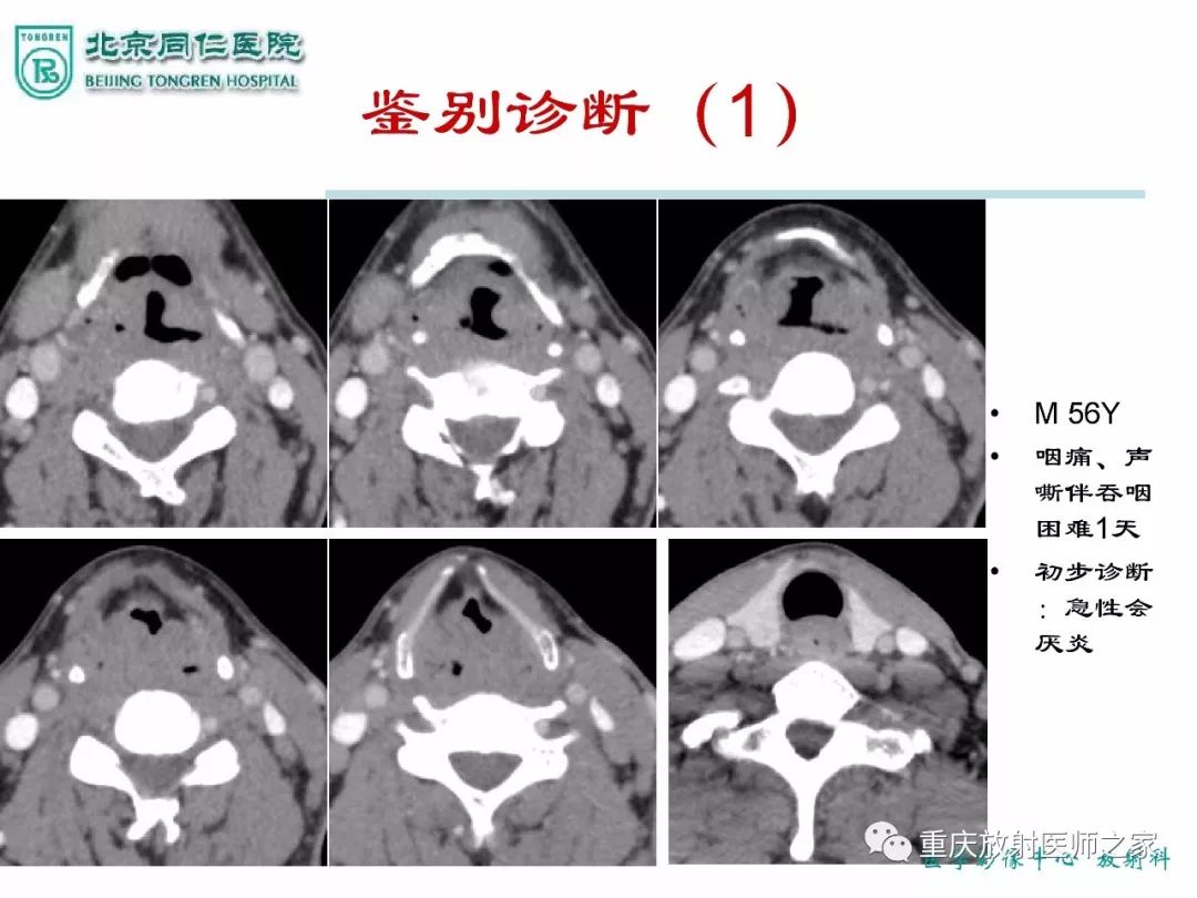 影像PPT - 【PPT】咽喉部病变影像分析-28