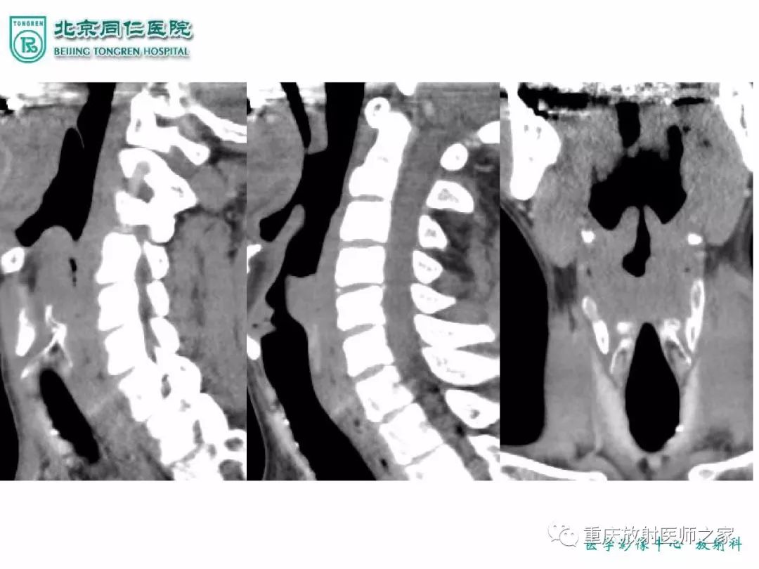 影像PPT - 【PPT】咽喉部病变影像分析-29
