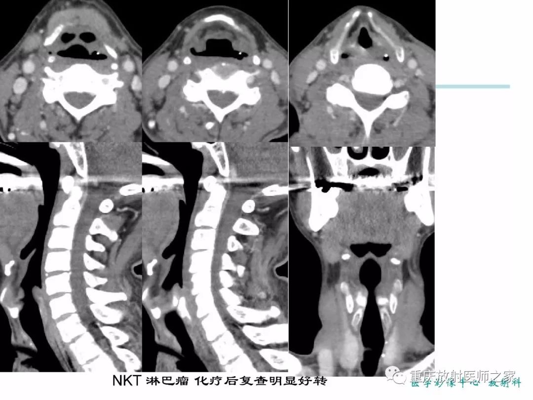 影像PPT - 【PPT】咽喉部病变影像分析-31