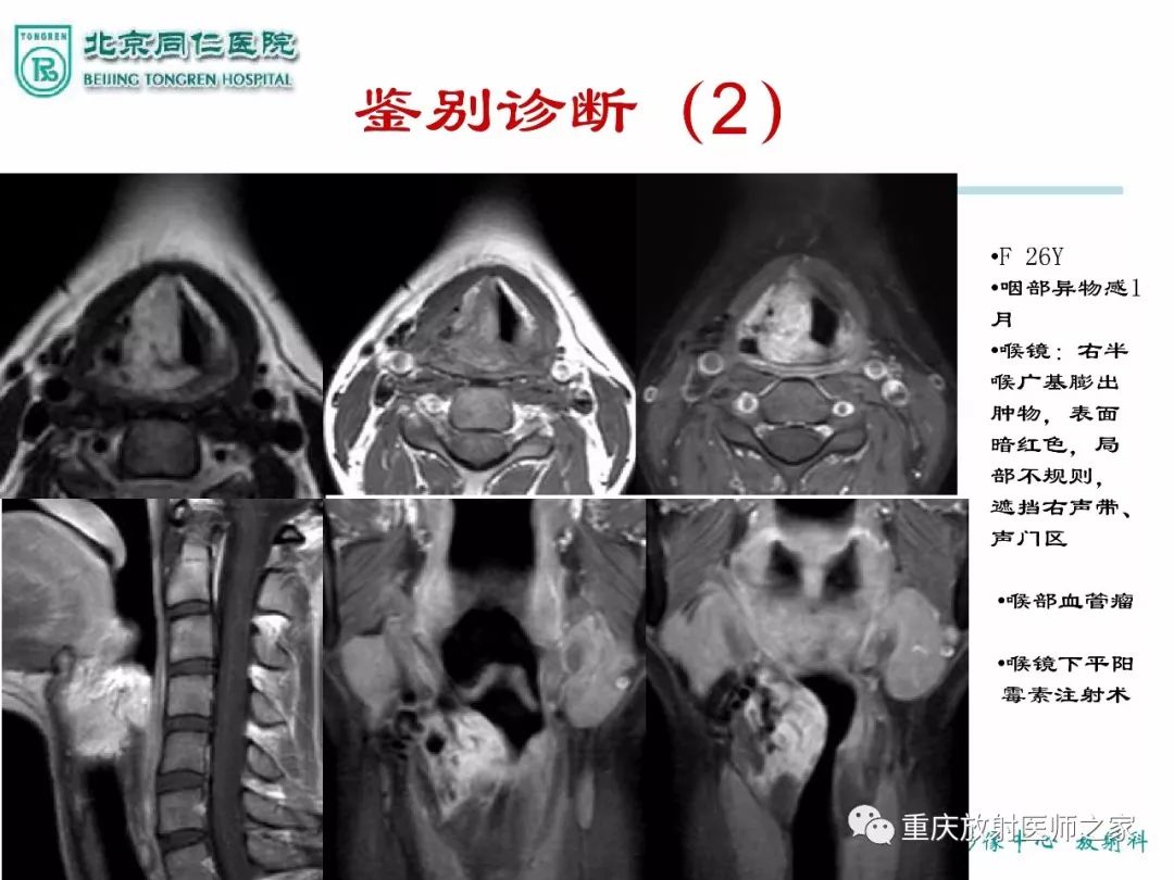 影像PPT - 【PPT】咽喉部病变影像分析-32