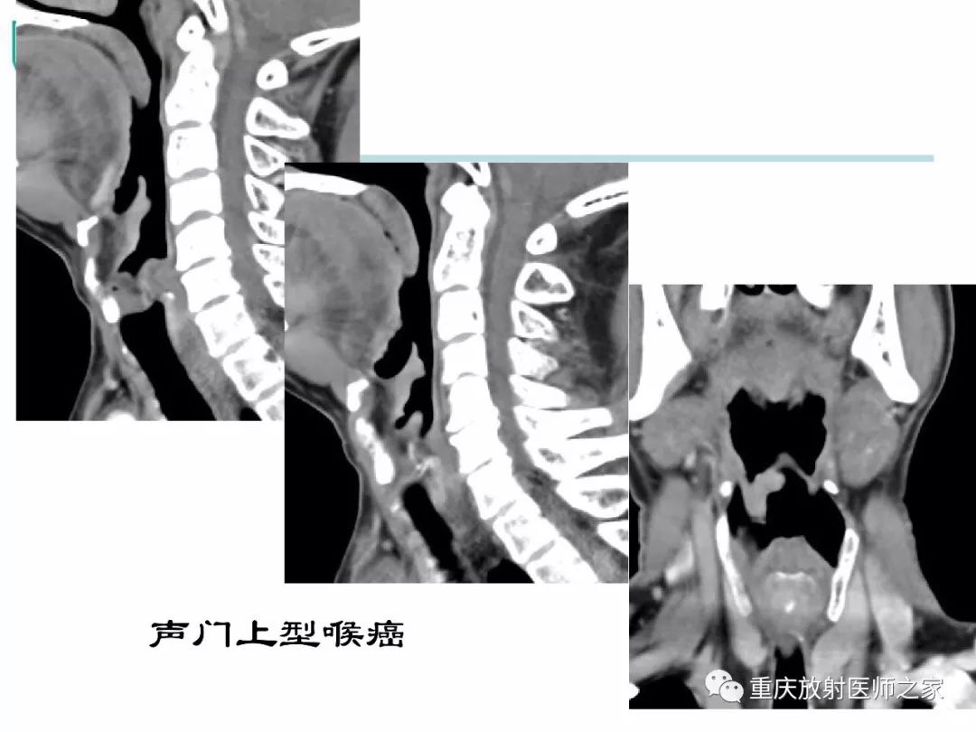 影像PPT - 【PPT】咽喉部病变影像分析-35