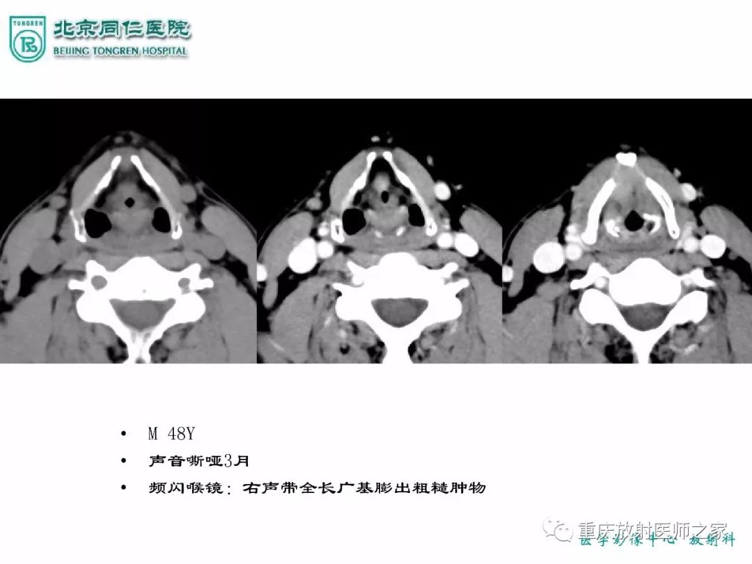 影像PPT - 【PPT】咽喉部病变影像分析-39