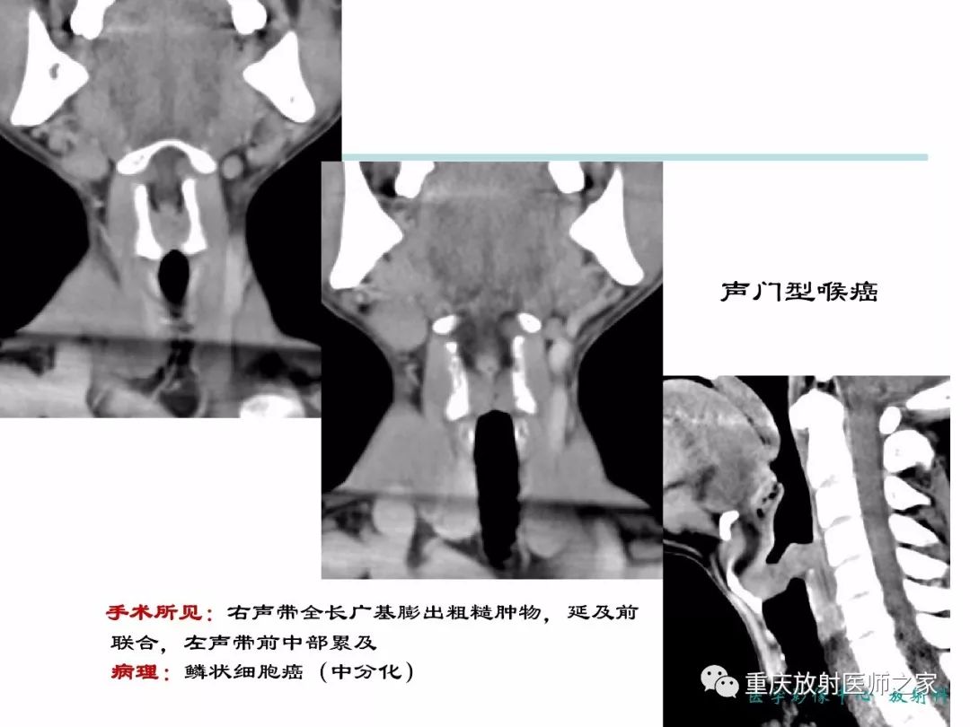 影像PPT - 【PPT】咽喉部病变影像分析-40