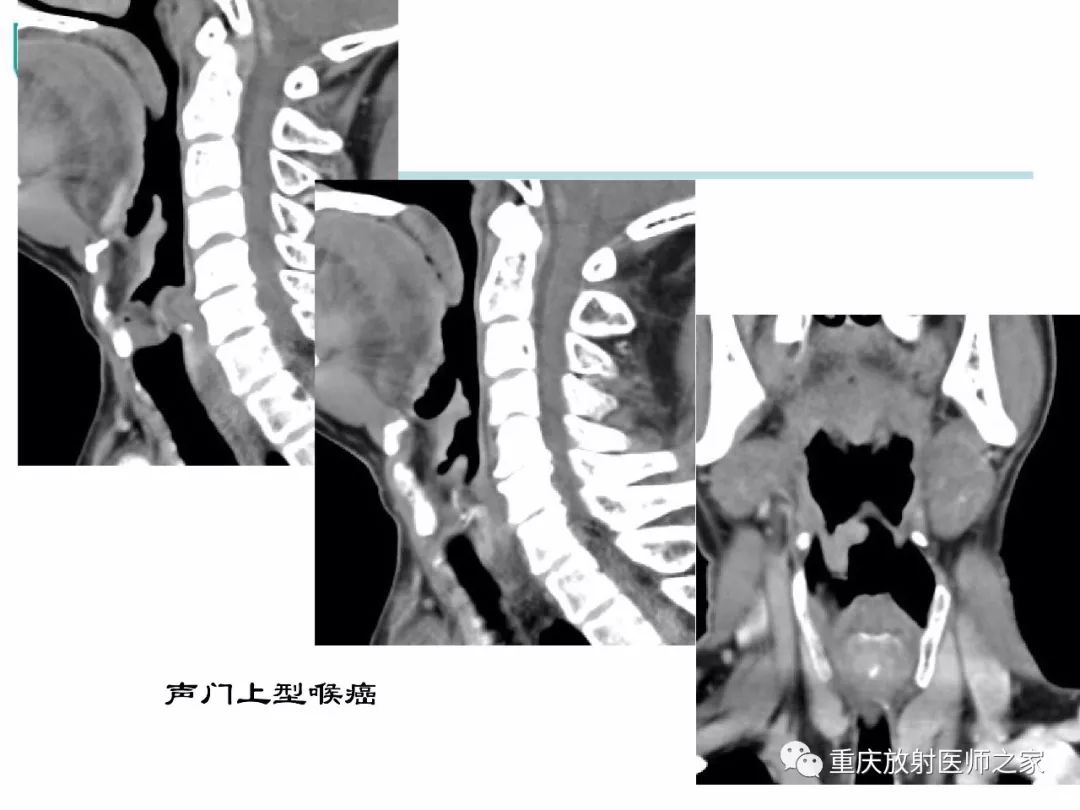 影像PPT - 【PPT】咽喉部病变影像分析-43