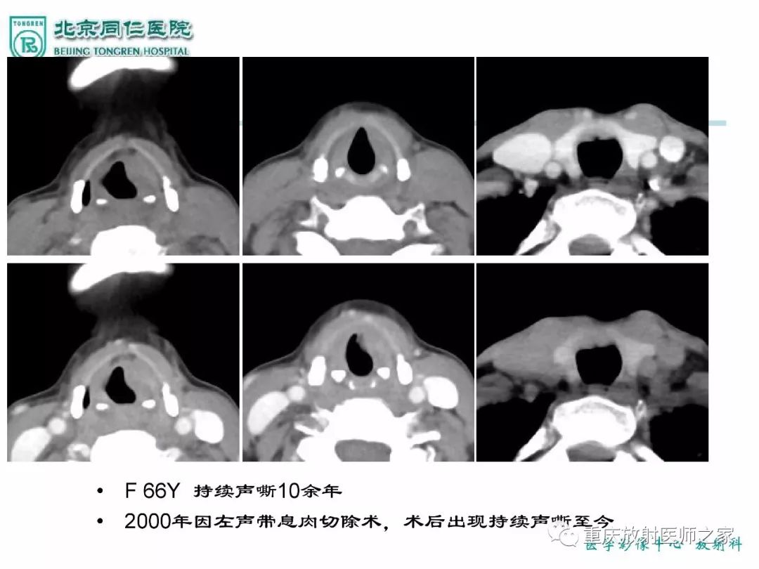 影像PPT - 【PPT】咽喉部病变影像分析-47