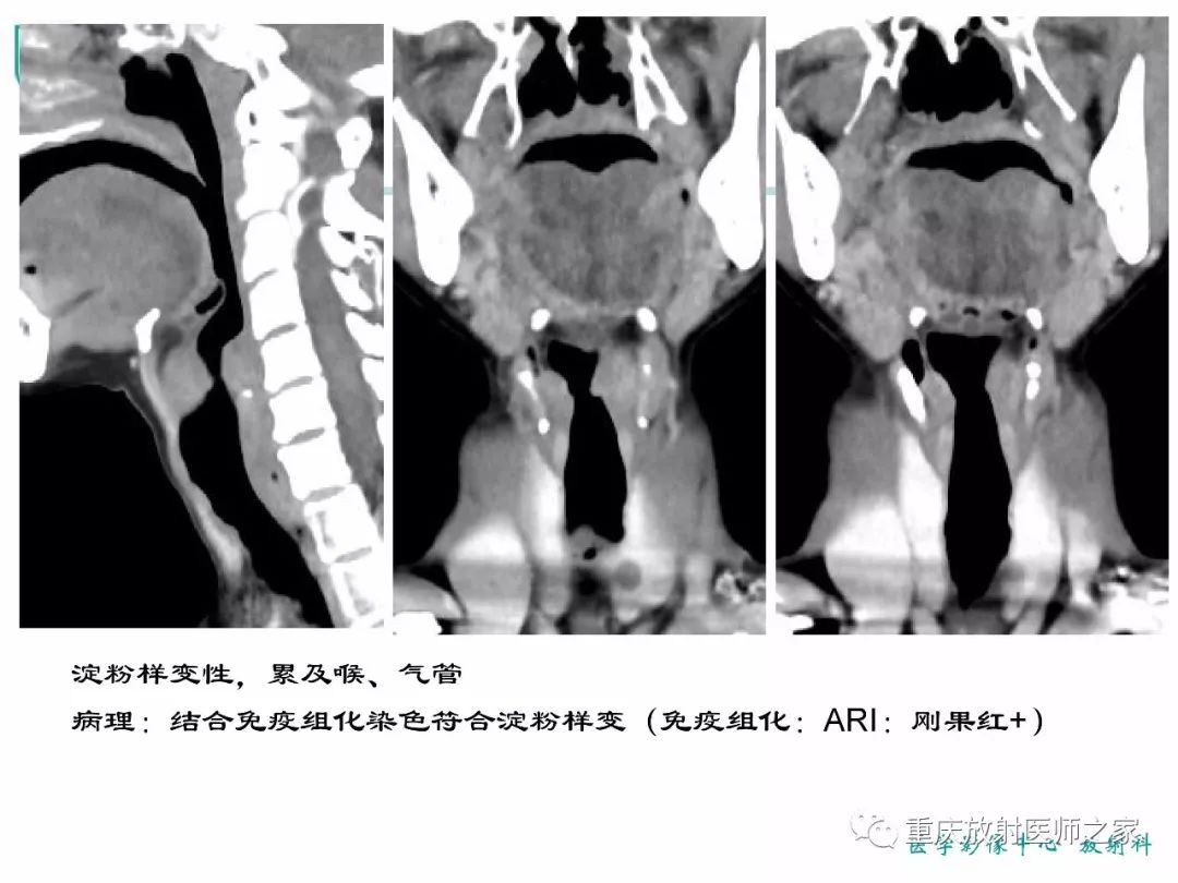 影像PPT - 【PPT】咽喉部病变影像分析-48