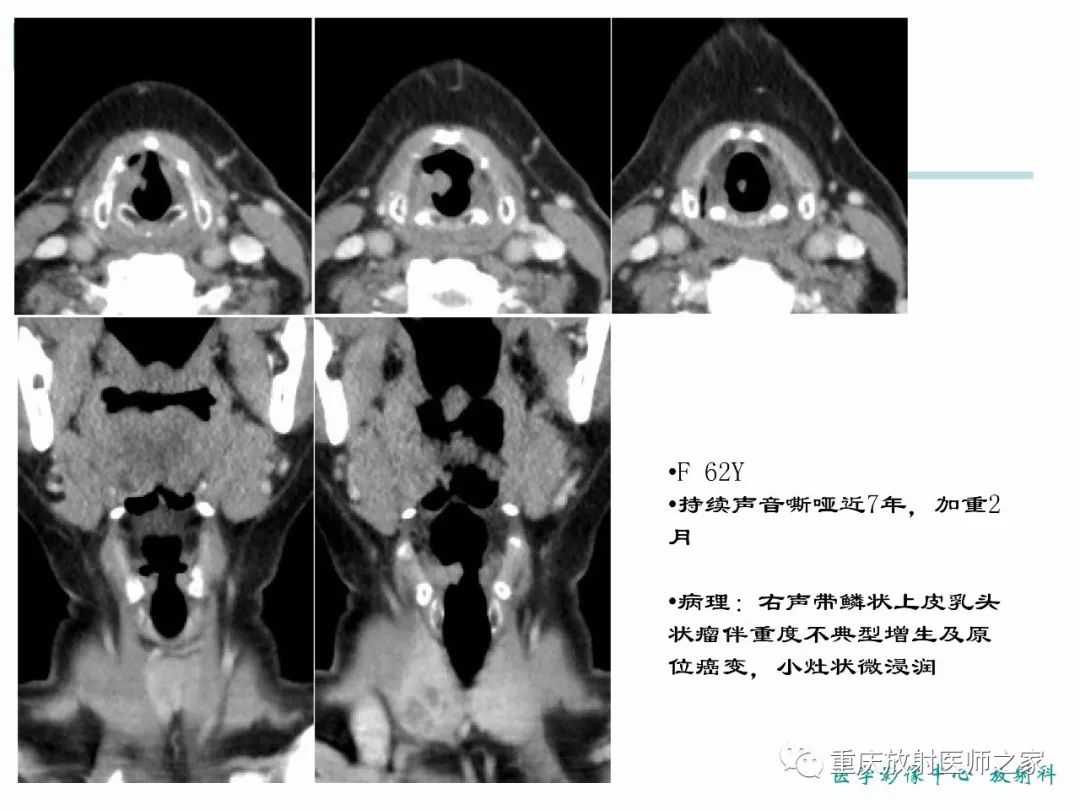 影像PPT - 【PPT】咽喉部病变影像分析-55