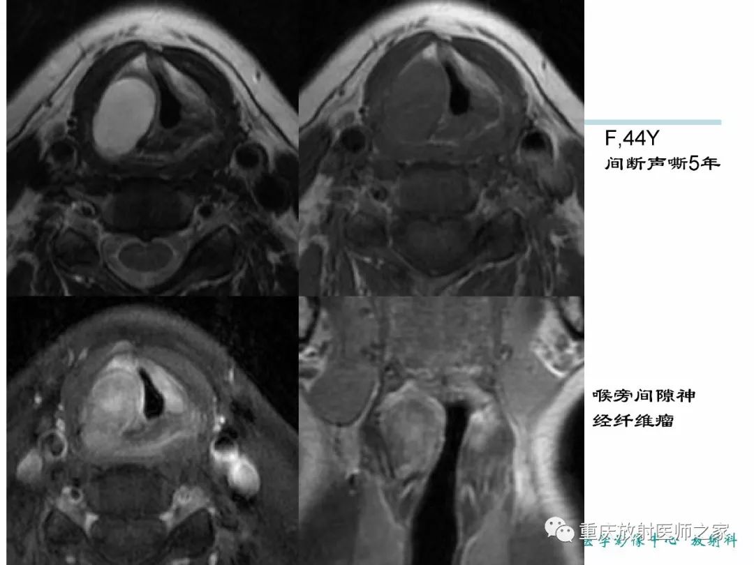 影像PPT - 【PPT】咽喉部病变影像分析-57