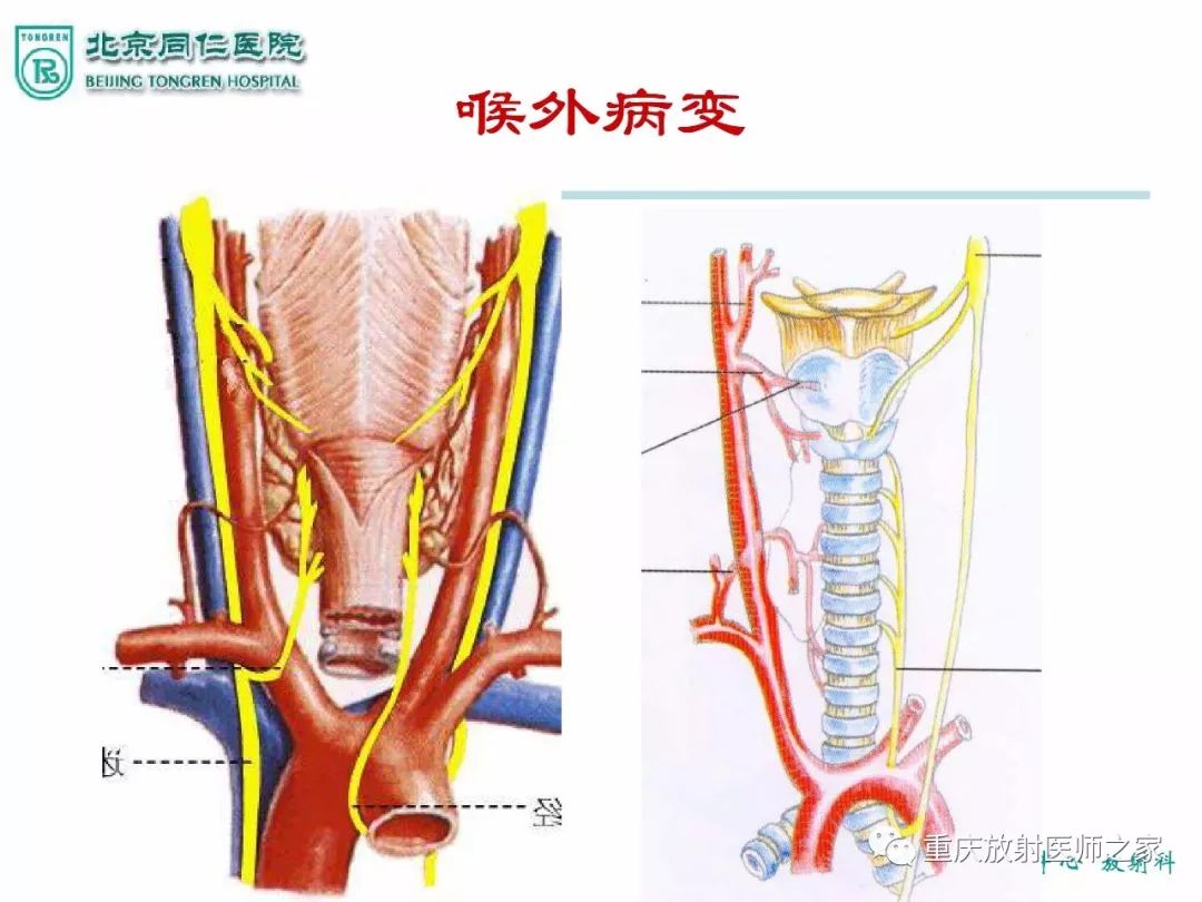 影像PPT - 【PPT】咽喉部病变影像分析-60