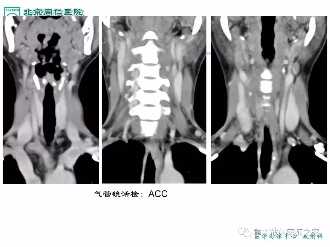 影像PPT - 【PPT】咽喉部病变影像分析-64