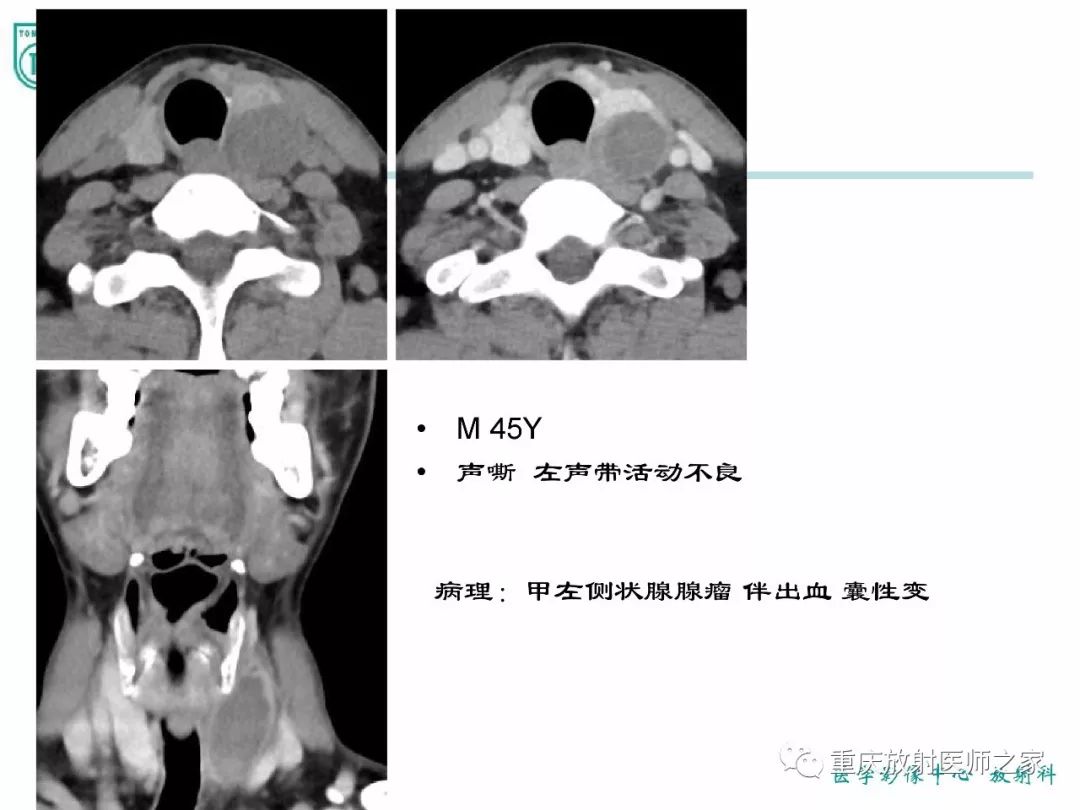影像PPT - 【PPT】咽喉部病变影像分析-67