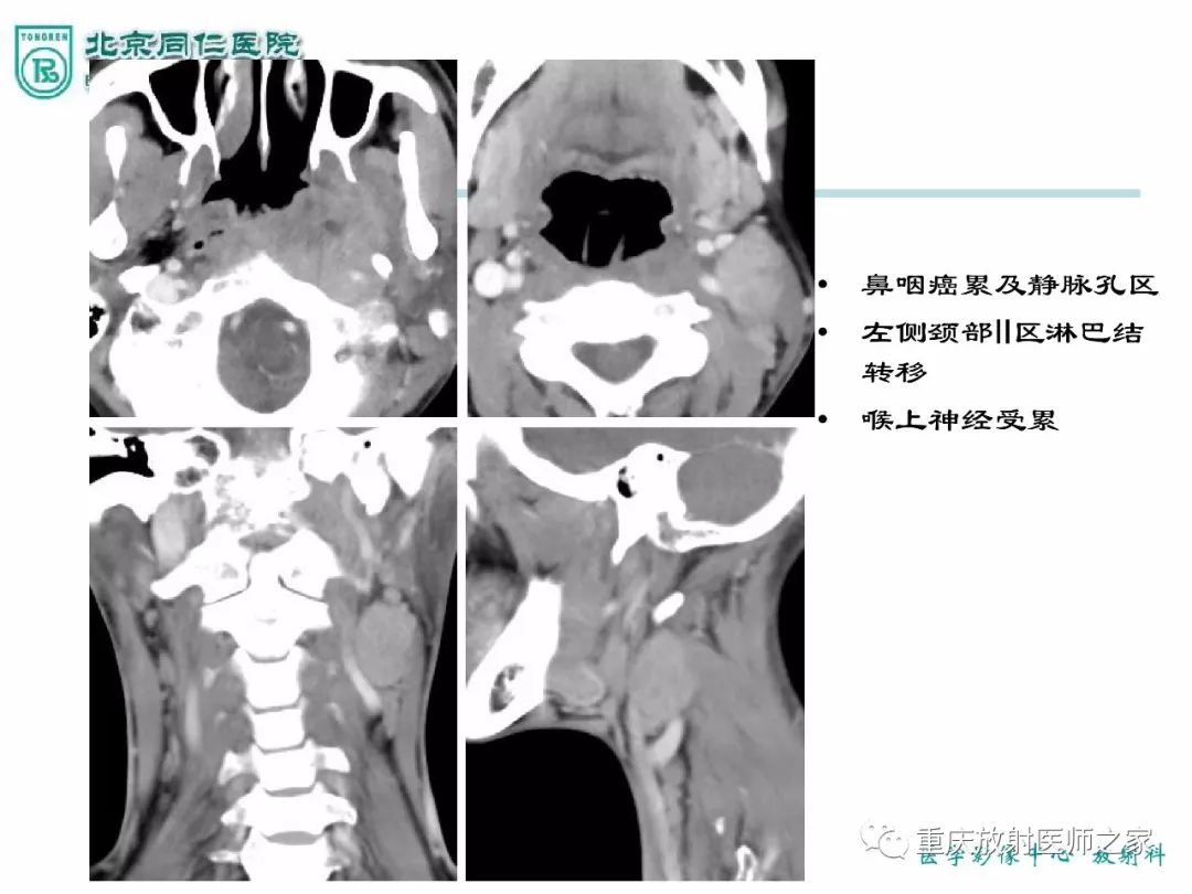 影像PPT - 【PPT】咽喉部病变影像分析-71