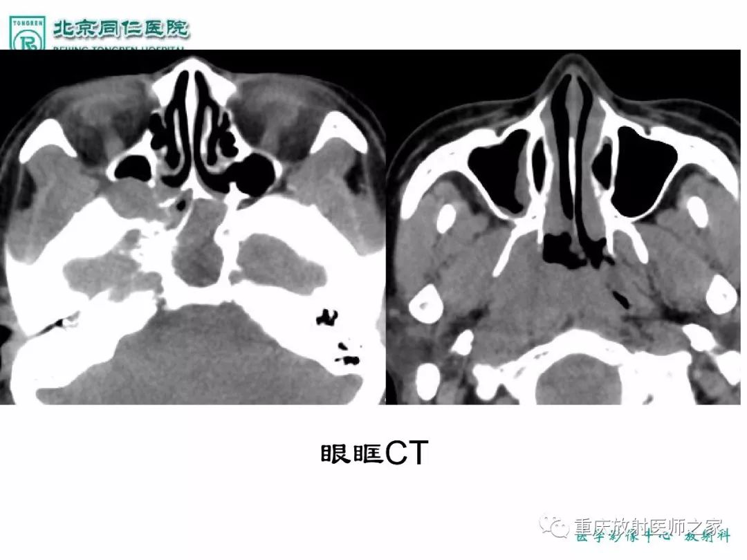 影像PPT - 【PPT】咽喉部病变影像分析-74
