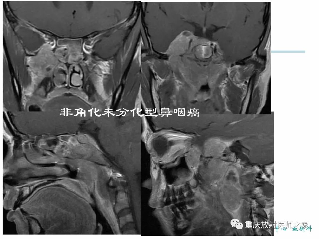 影像PPT - 【PPT】咽喉部病变影像分析-79