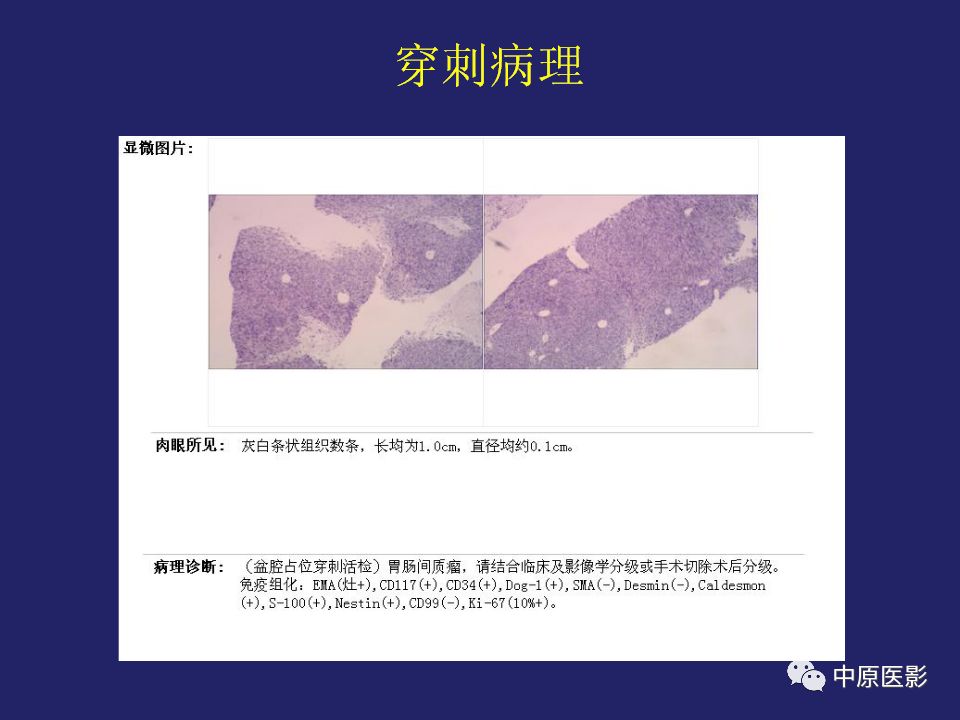 影像PPT - 【病例】直肠间质瘤1例CT及MR影像-11