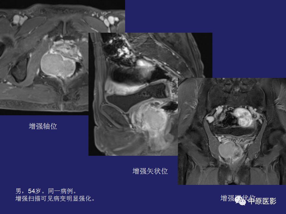 影像PPT - 【病例】直肠间质瘤1例CT及MR影像-16