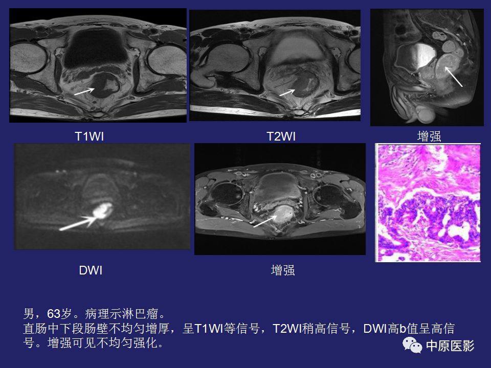 影像PPT - 【病例】直肠间质瘤1例CT及MR影像-21