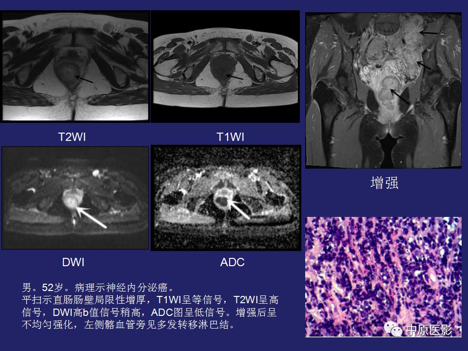 影像PPT - 【病例】直肠间质瘤1例CT及MR影像-23
