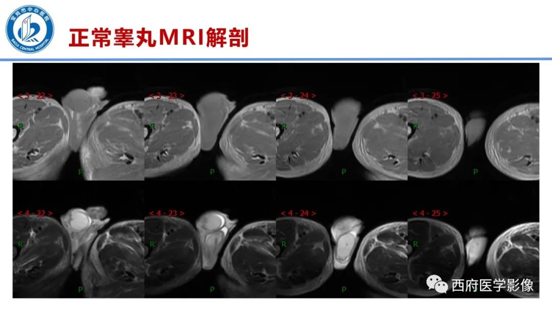 影像PPT - 【PPT】睾丸肿瘤及肿瘤样病变影像诊断与鉴别-6