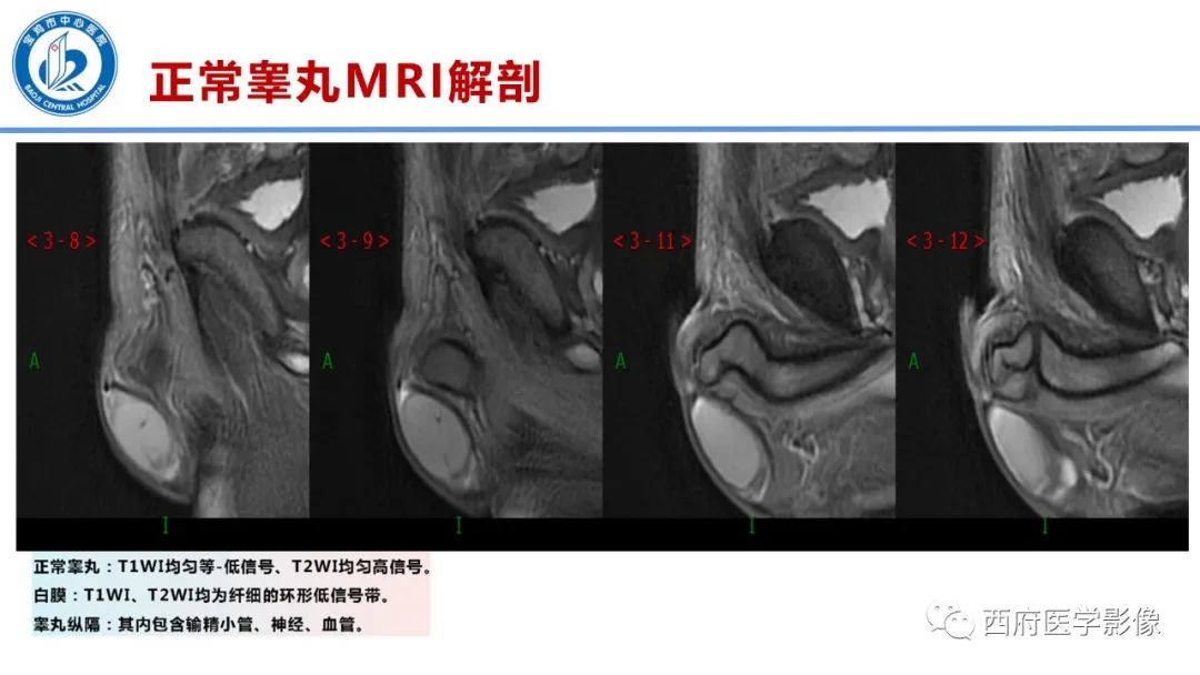 影像PPT - 【PPT】睾丸肿瘤及肿瘤样病变影像诊断与鉴别-7