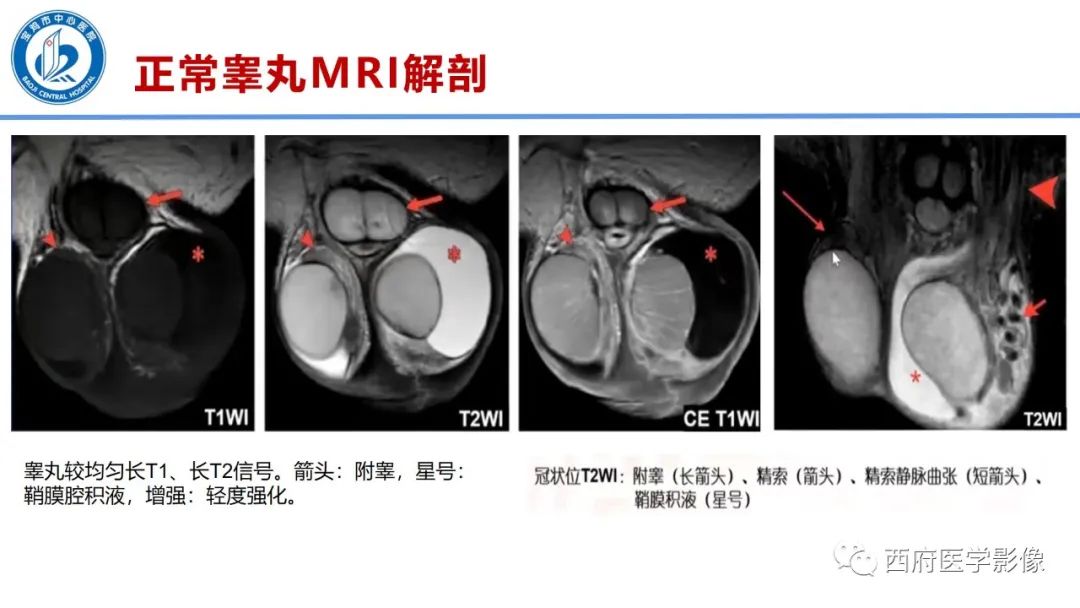 影像PPT - 【PPT】睾丸肿瘤及肿瘤样病变影像诊断与鉴别-8