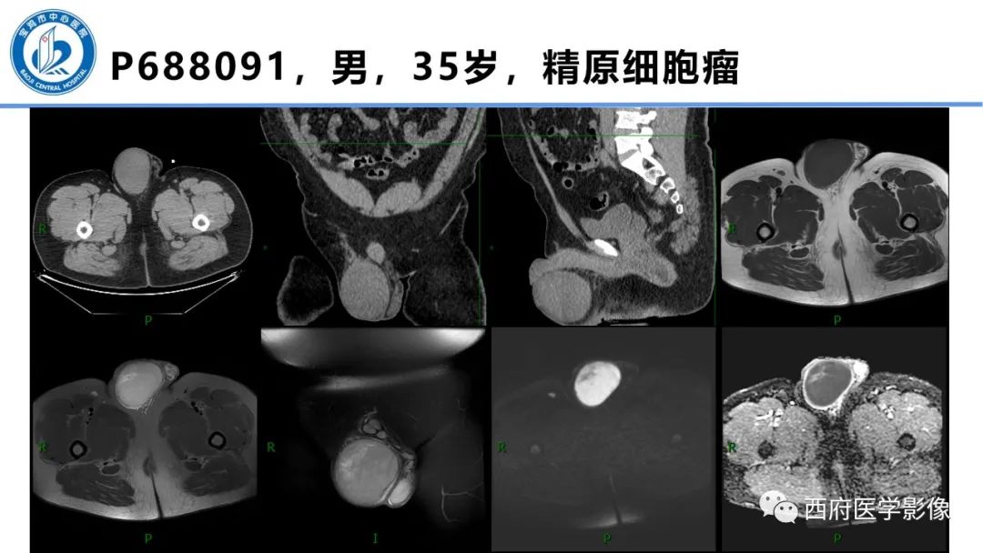 影像PPT - 【PPT】睾丸肿瘤及肿瘤样病变影像诊断与鉴别-15