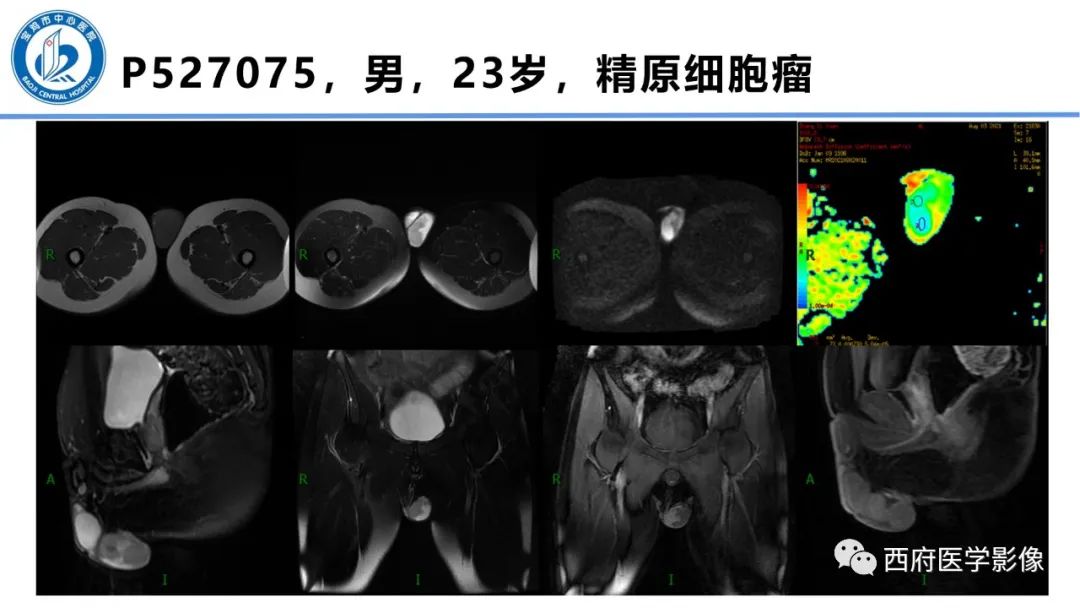 影像PPT - 【PPT】睾丸肿瘤及肿瘤样病变影像诊断与鉴别-16
