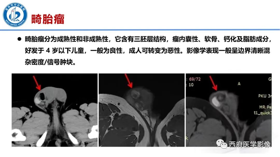 影像PPT - 【PPT】睾丸肿瘤及肿瘤样病变影像诊断与鉴别-17