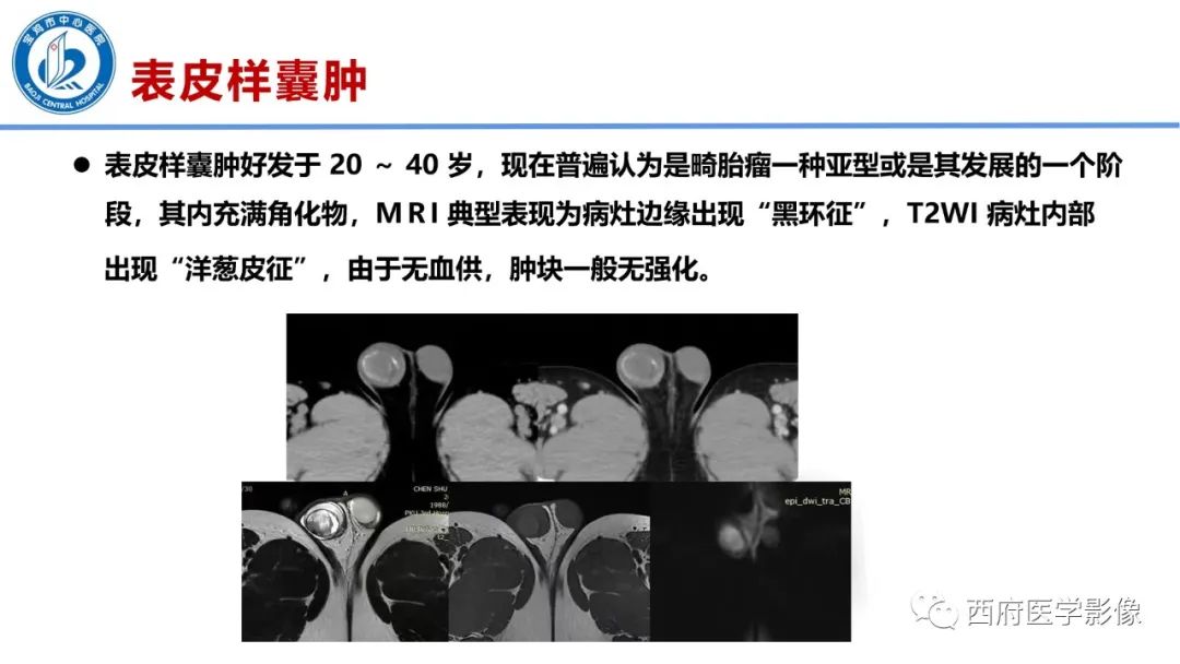 影像PPT - 【PPT】睾丸肿瘤及肿瘤样病变影像诊断与鉴别-18
