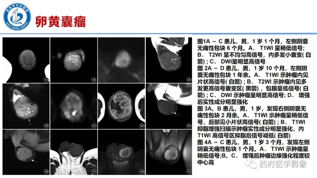 影像PPT - 【PPT】睾丸肿瘤及肿瘤样病变影像诊断与鉴别-20