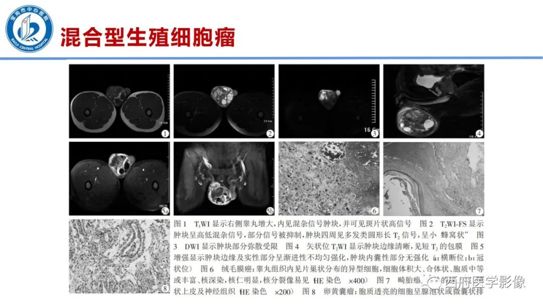 影像PPT - 【PPT】睾丸肿瘤及肿瘤样病变影像诊断与鉴别-22