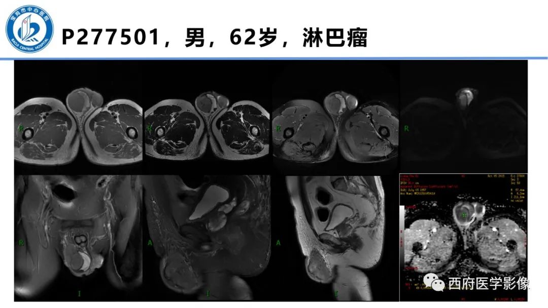 影像PPT - 【PPT】睾丸肿瘤及肿瘤样病变影像诊断与鉴别-26
