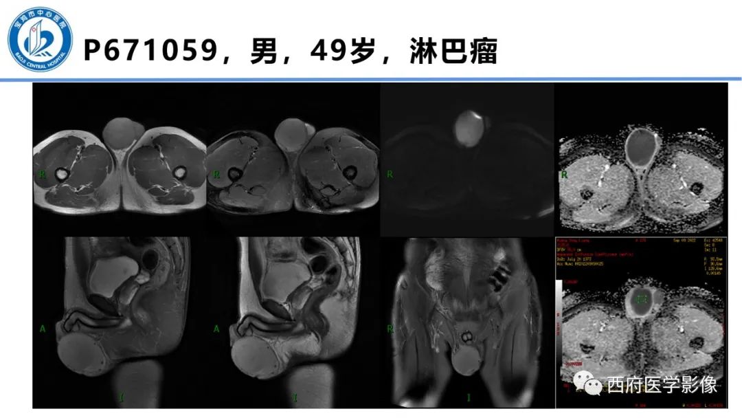 影像PPT - 【PPT】睾丸肿瘤及肿瘤样病变影像诊断与鉴别-27