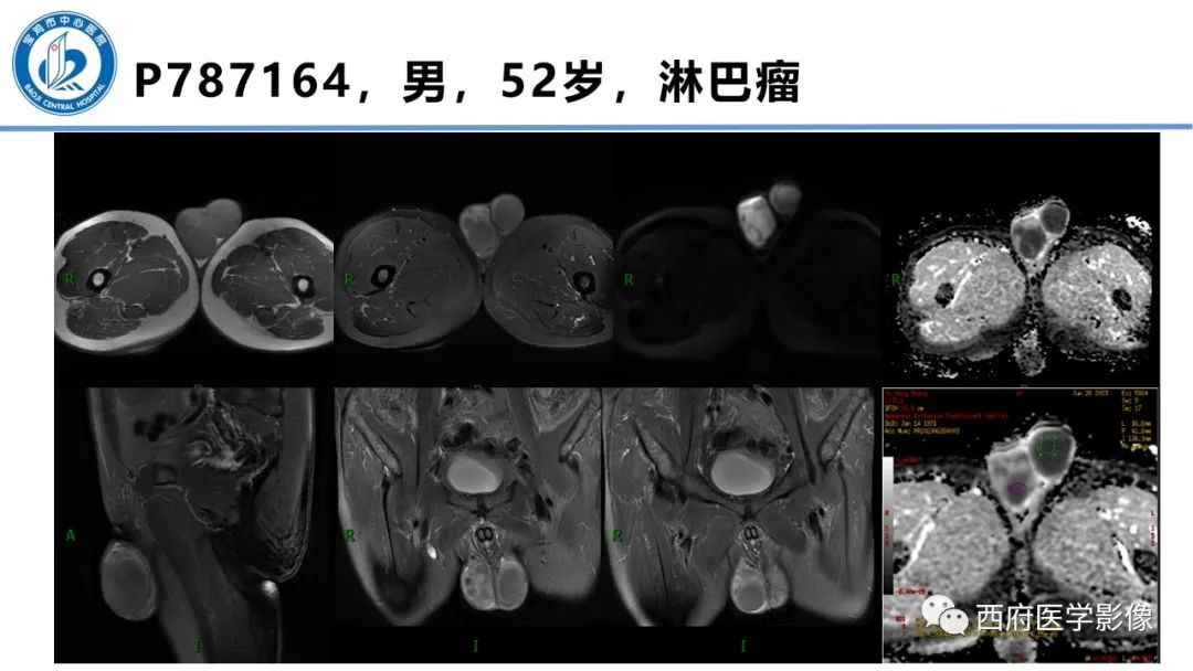 影像PPT - 【PPT】睾丸肿瘤及肿瘤样病变影像诊断与鉴别-28