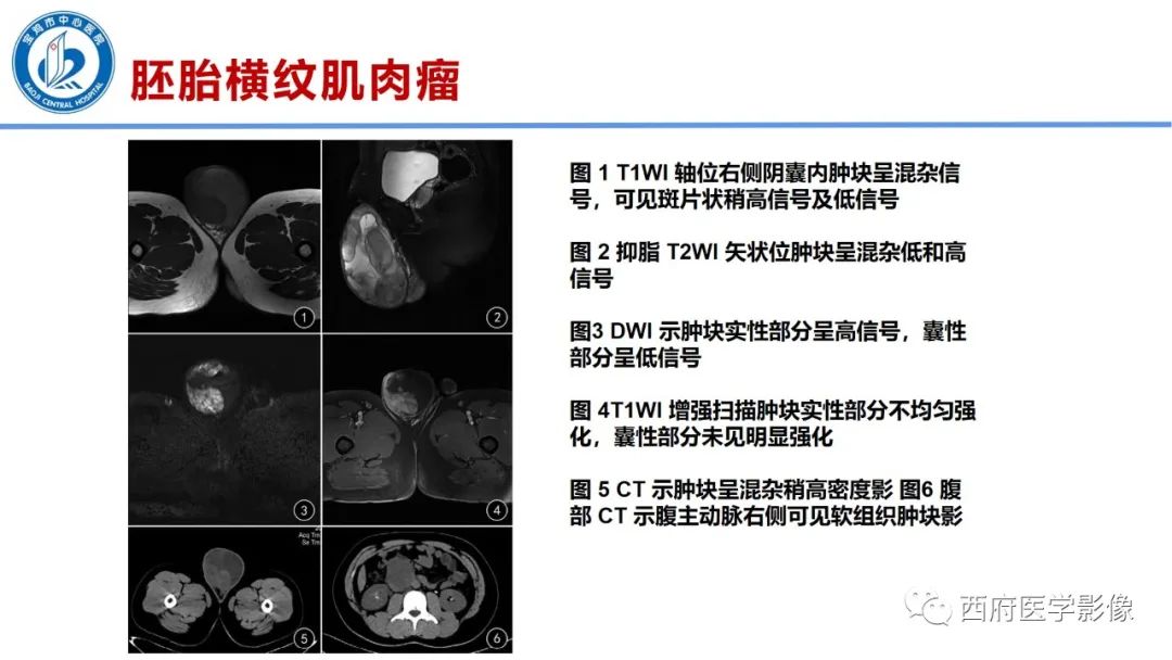 影像PPT - 【PPT】睾丸肿瘤及肿瘤样病变影像诊断与鉴别-30