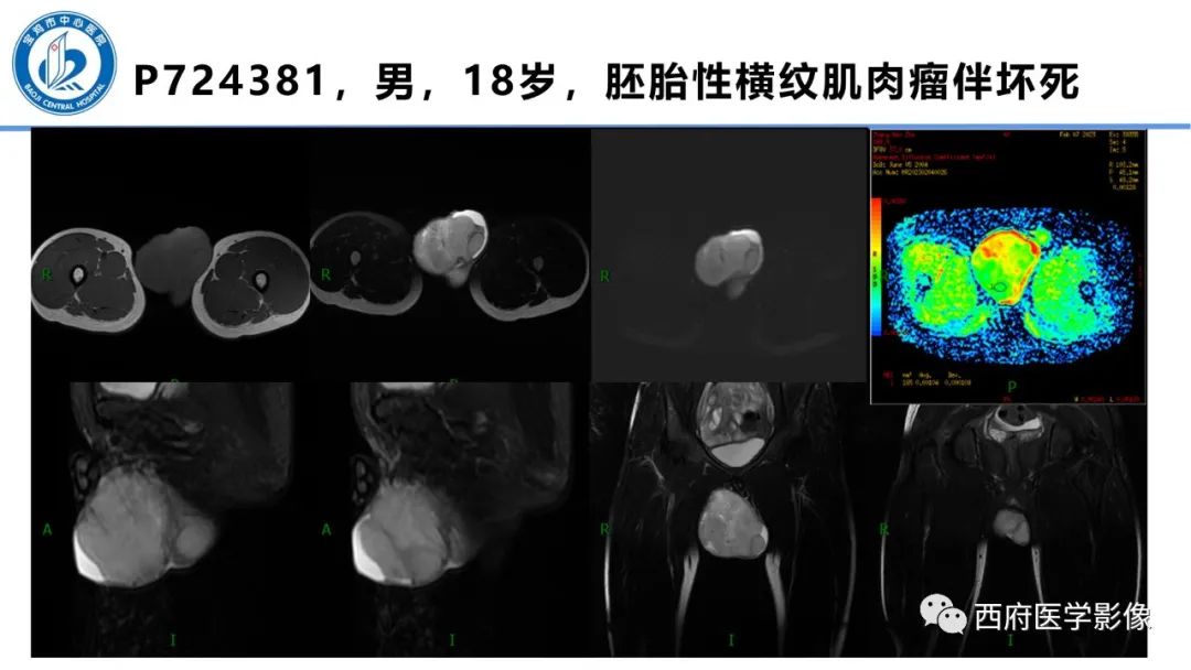 影像PPT - 【PPT】睾丸肿瘤及肿瘤样病变影像诊断与鉴别-31