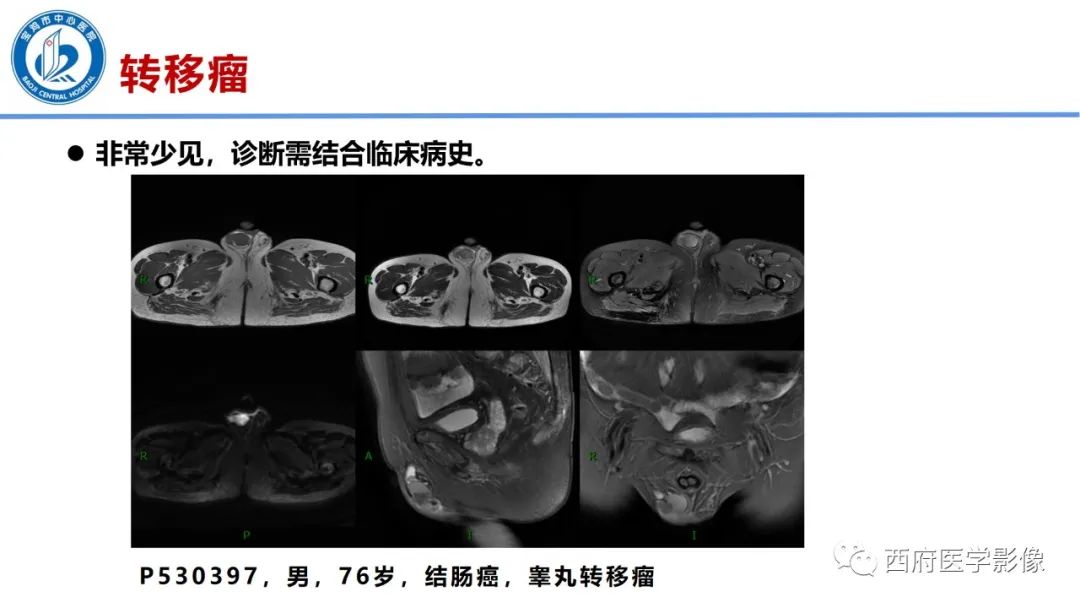 影像PPT - 【PPT】睾丸肿瘤及肿瘤样病变影像诊断与鉴别-33