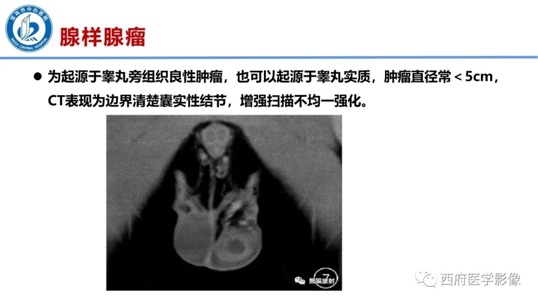 影像PPT - 【PPT】睾丸肿瘤及肿瘤样病变影像诊断与鉴别-34