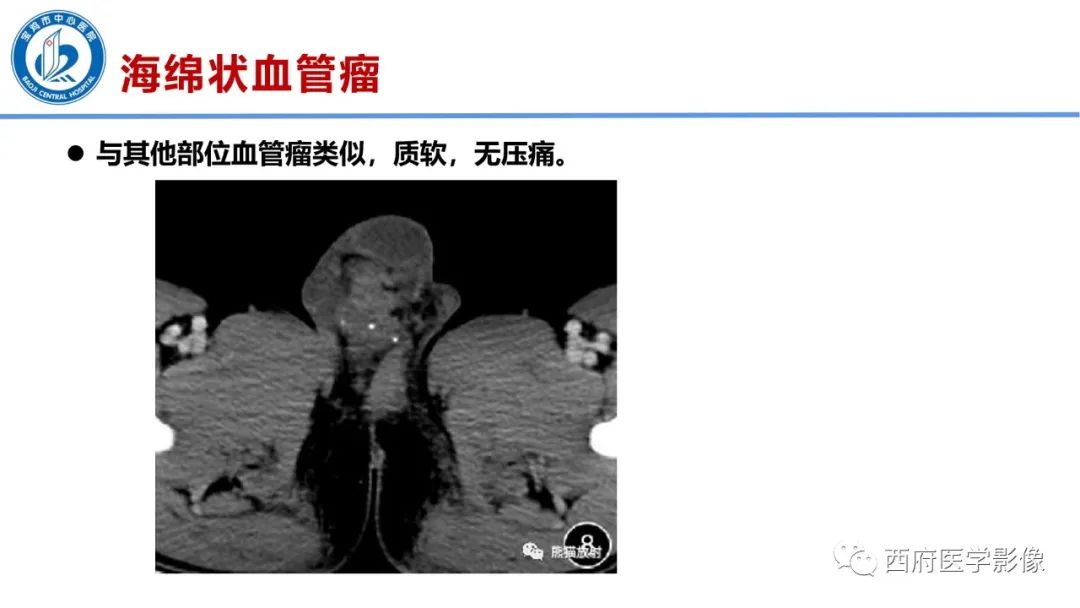 影像PPT - 【PPT】睾丸肿瘤及肿瘤样病变影像诊断与鉴别-35