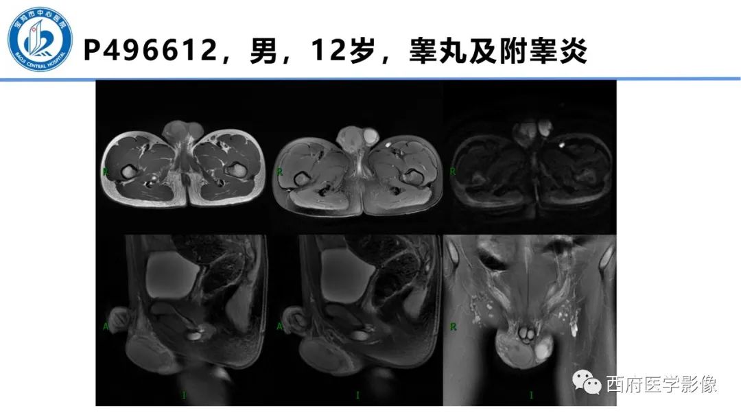 影像PPT - 【PPT】睾丸肿瘤及肿瘤样病变影像诊断与鉴别-37