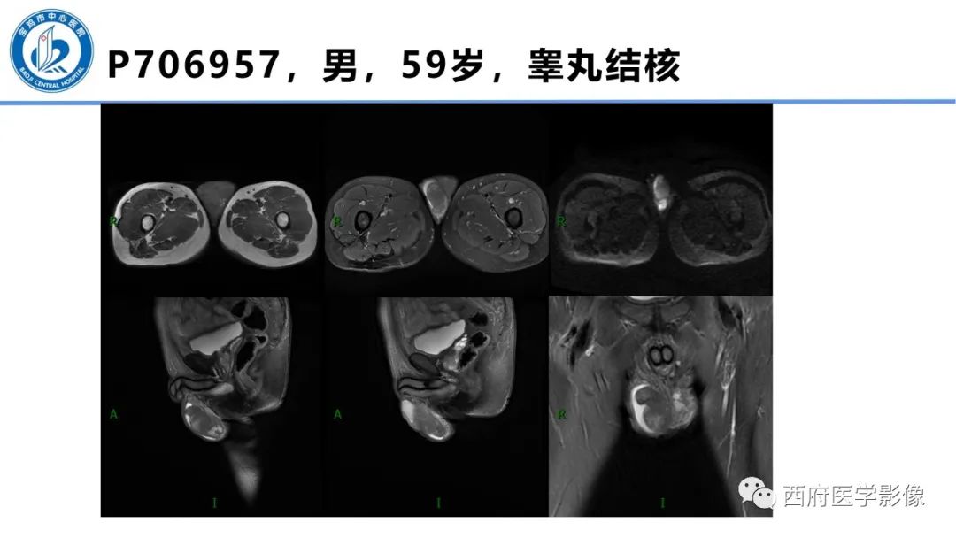 影像PPT - 【PPT】睾丸肿瘤及肿瘤样病变影像诊断与鉴别-39