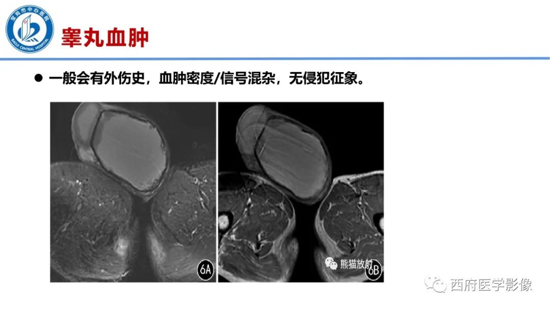 影像PPT - 【PPT】睾丸肿瘤及肿瘤样病变影像诊断与鉴别-40