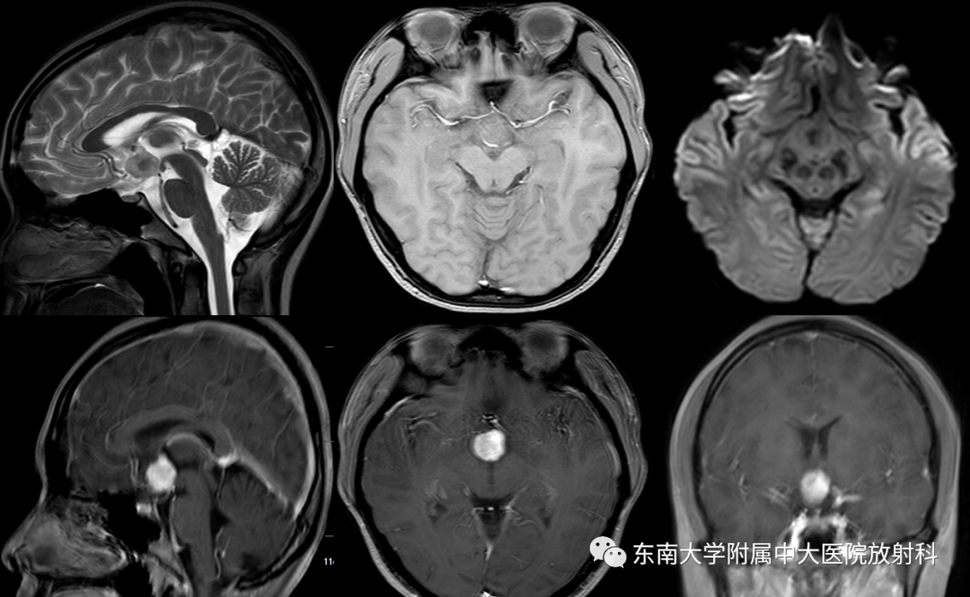 影像PPT - 【PPT】垂体细胞瘤-2