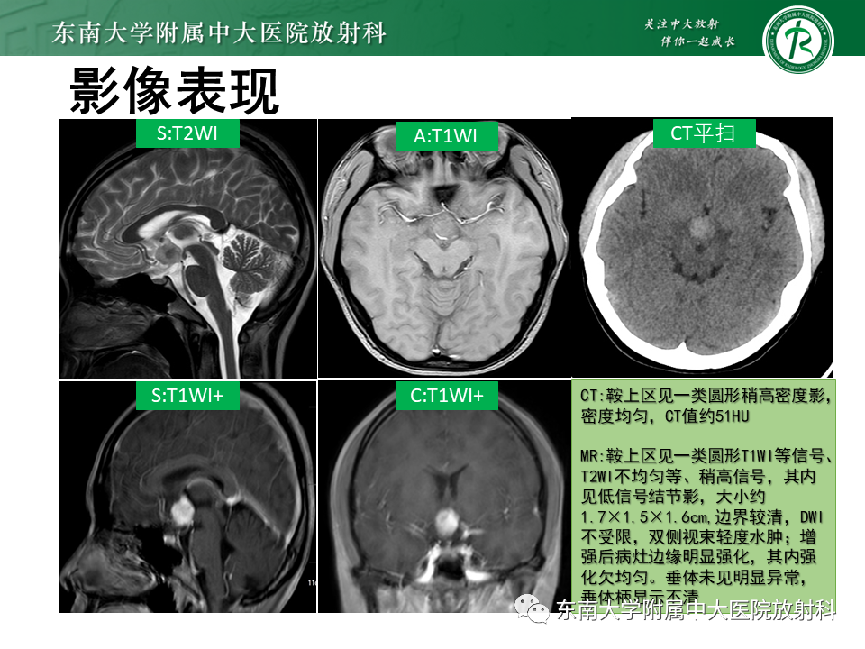 影像PPT - 【PPT】垂体细胞瘤-3