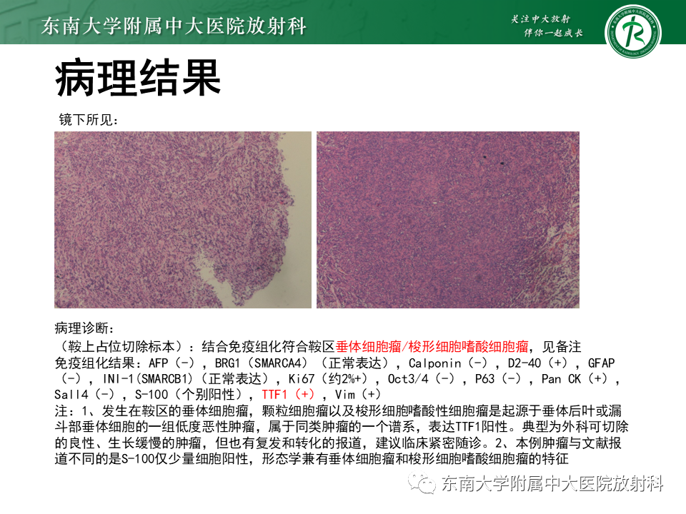 影像PPT - 【PPT】垂体细胞瘤-5