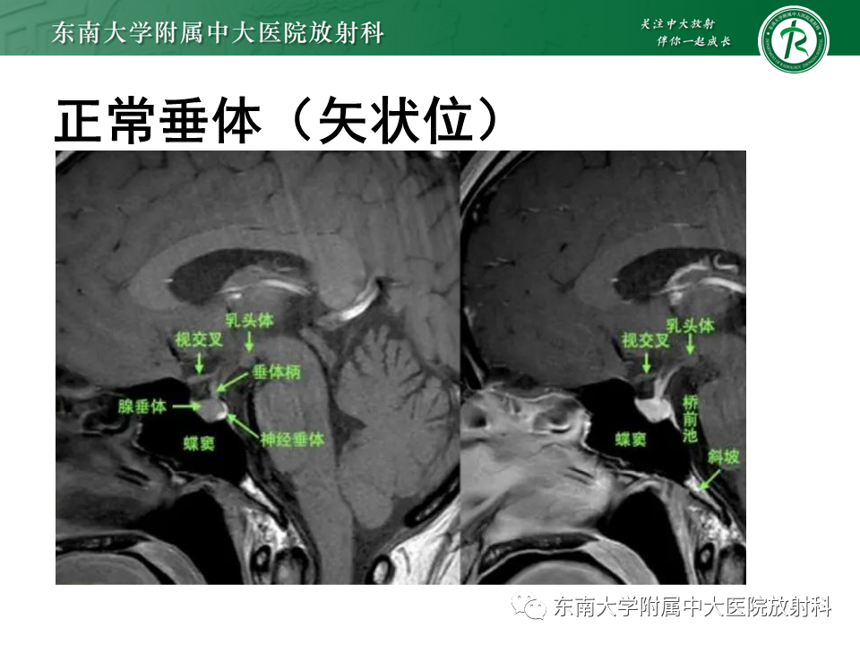 影像PPT - 【PPT】垂体细胞瘤-9